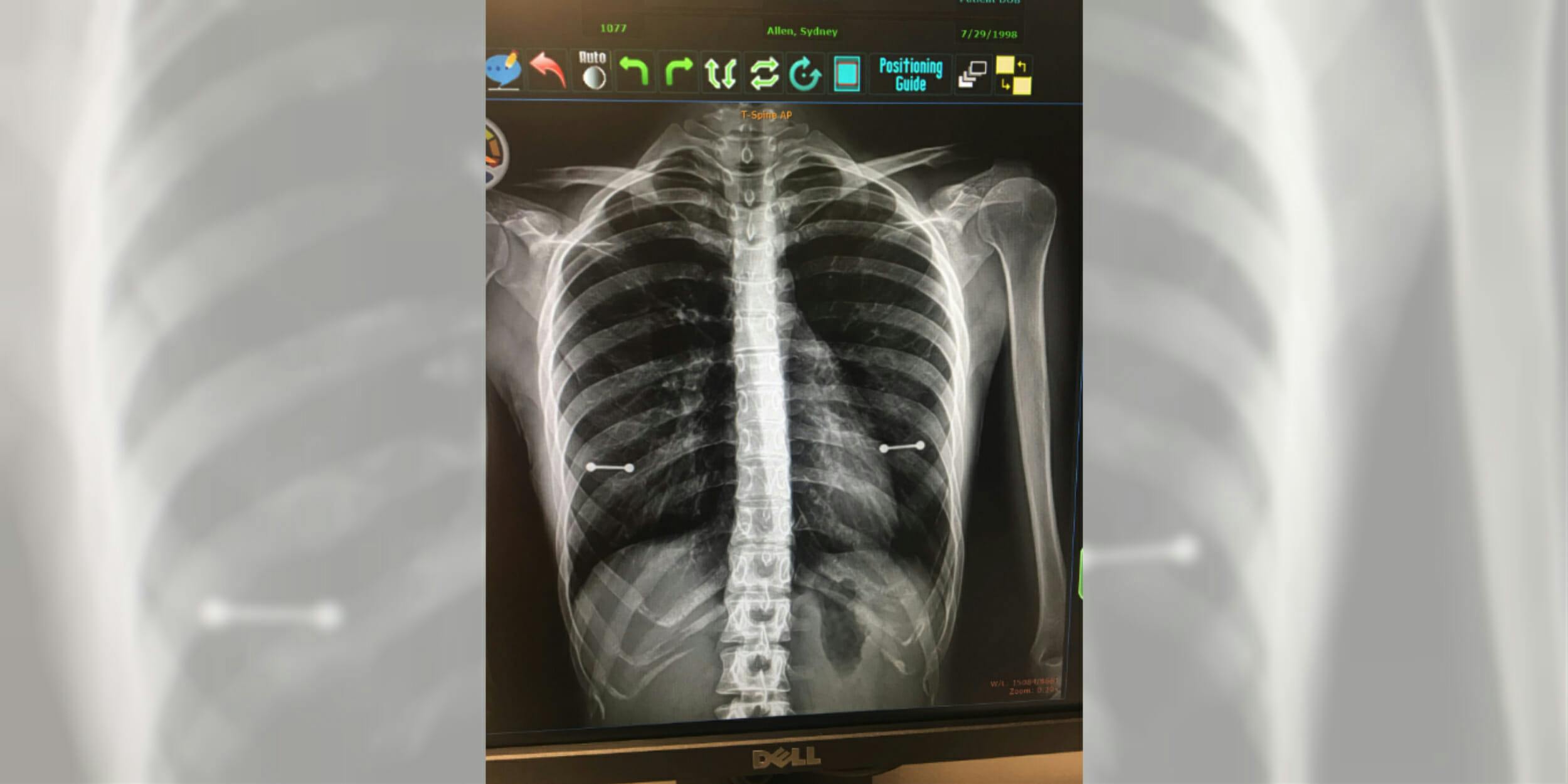 Mom learns of her 20-year-old daughter’s nipple piercings from an X-ray